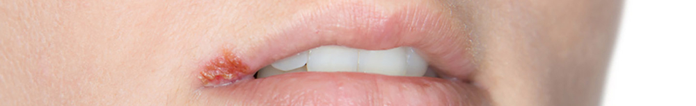 Comment anticiper et gu&eacute;rir le bouton de fi&egrave;vre ?