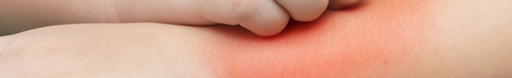 Dermatite atopique b&eacute;b&eacute; : comment la traiter ou la pr&eacute;venir ?