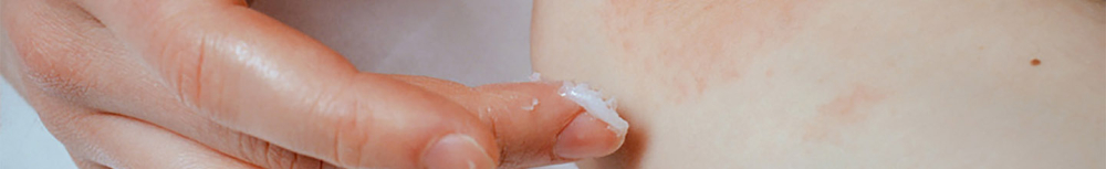 Qu'est-ce que la dermite s&eacute;borrh&eacute;ique ?