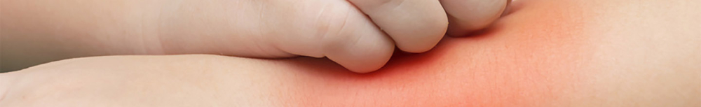 Peut-on soigner l'eczema avec des huiles essentielles ?