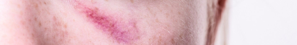 Quelles huiles essentielles choisir pour un h&eacute;matome ?