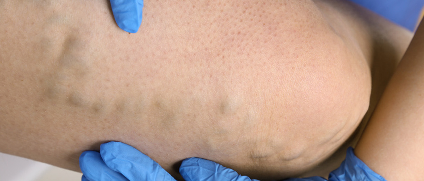 traitement chirurgical des hemorroides