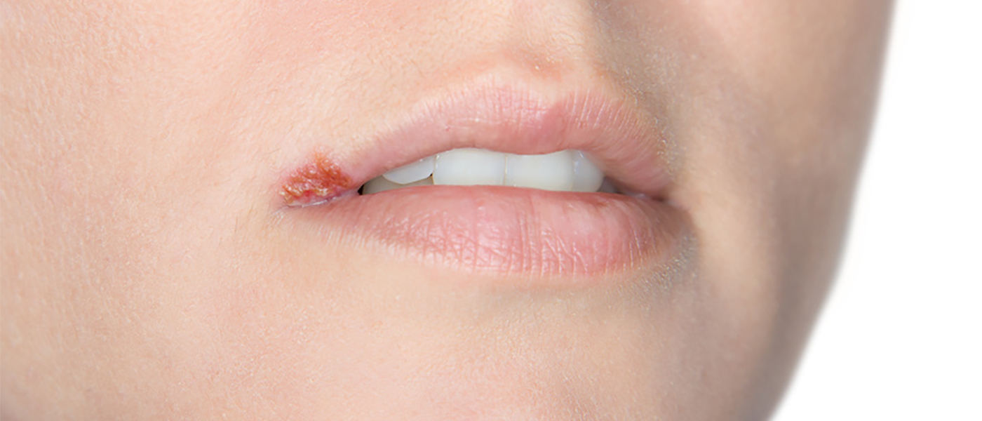 herpes labial