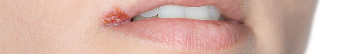 Quelles sont les causes d&rsquo;un bouton de fi&egrave;vre ?