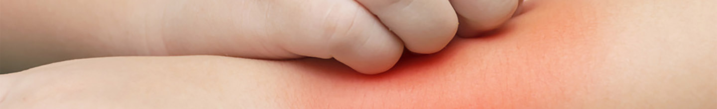 Peut-on soigner l'eczema avec des huiles essentielles ?