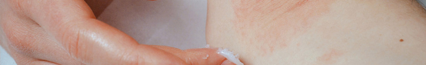 Qu'est ce que l'ecz&eacute;ma chez l'adulte ?