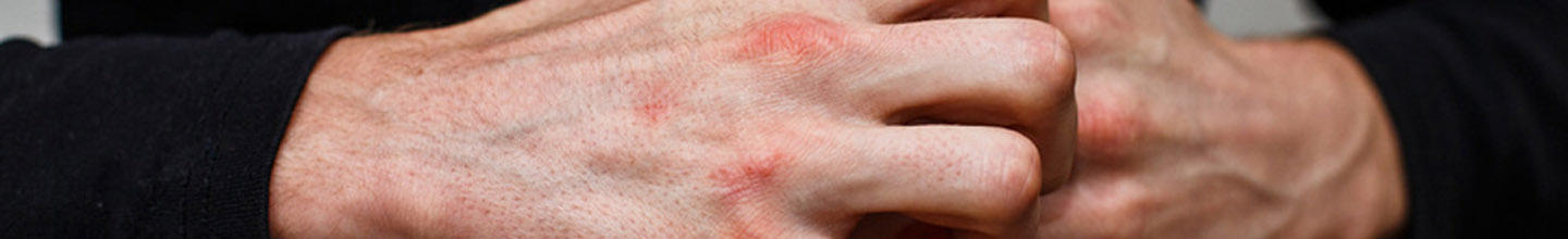 Que faut-il savoir sur l'ecz&eacute;ma et les probiotiques ?