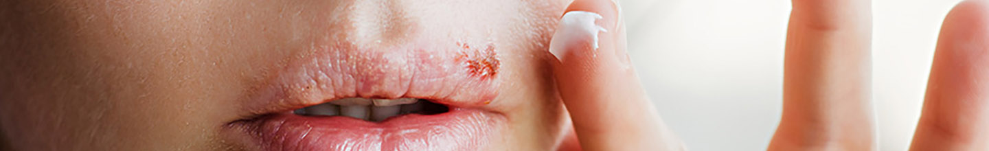 Comment soigner rapidement un bouton de fi&egrave;vre sur la l&egrave;vre ?