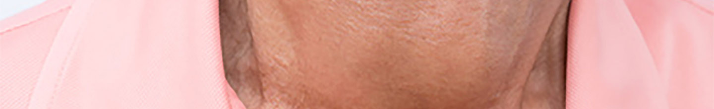 Qu'est-ce qu'un oedeme de quincke ?