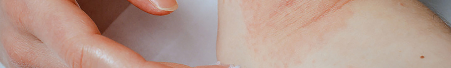 Quelles sont les causes du psoriasis ?