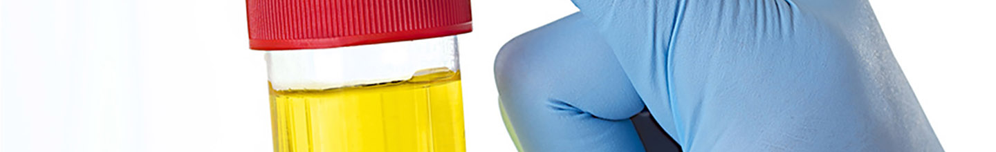 Quels sont les sympt&ocirc;mes de la cystite ?