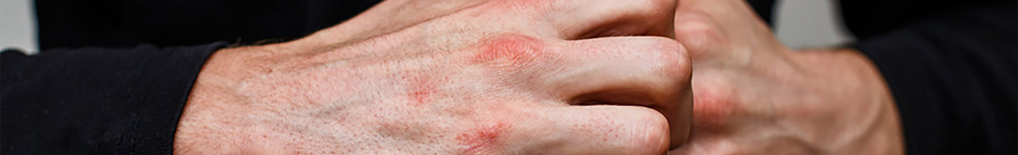 Qu'est ce que la teigne ?