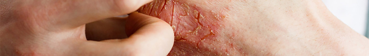 Quelles sont les crèmes sans ordonnance contre l'eczéma ?