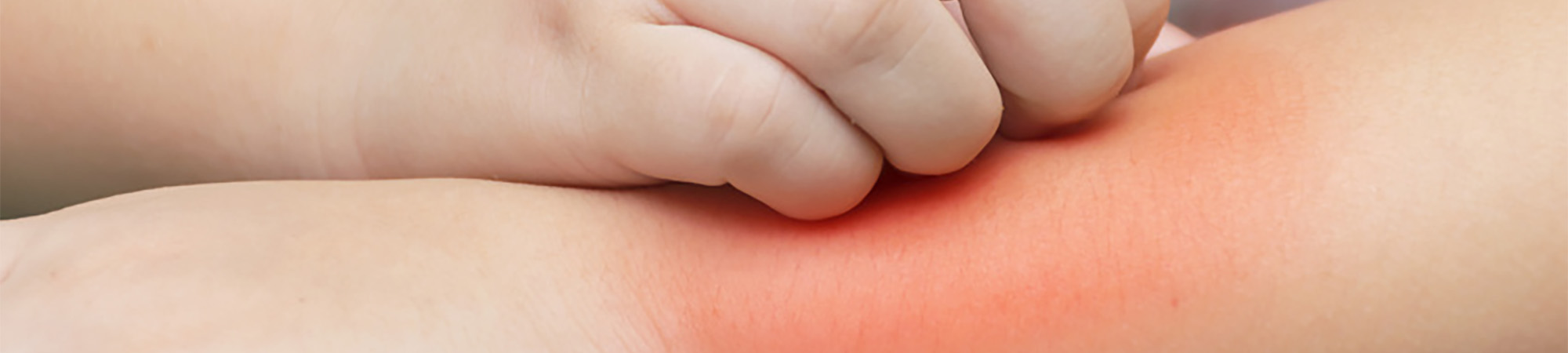 Peut on soigner l'urticaire avec un antihistaminique ?